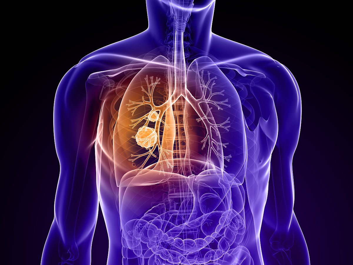 小心！过量补充维生素C和E，会促进肺癌生长和转移！
