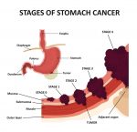 胃癌